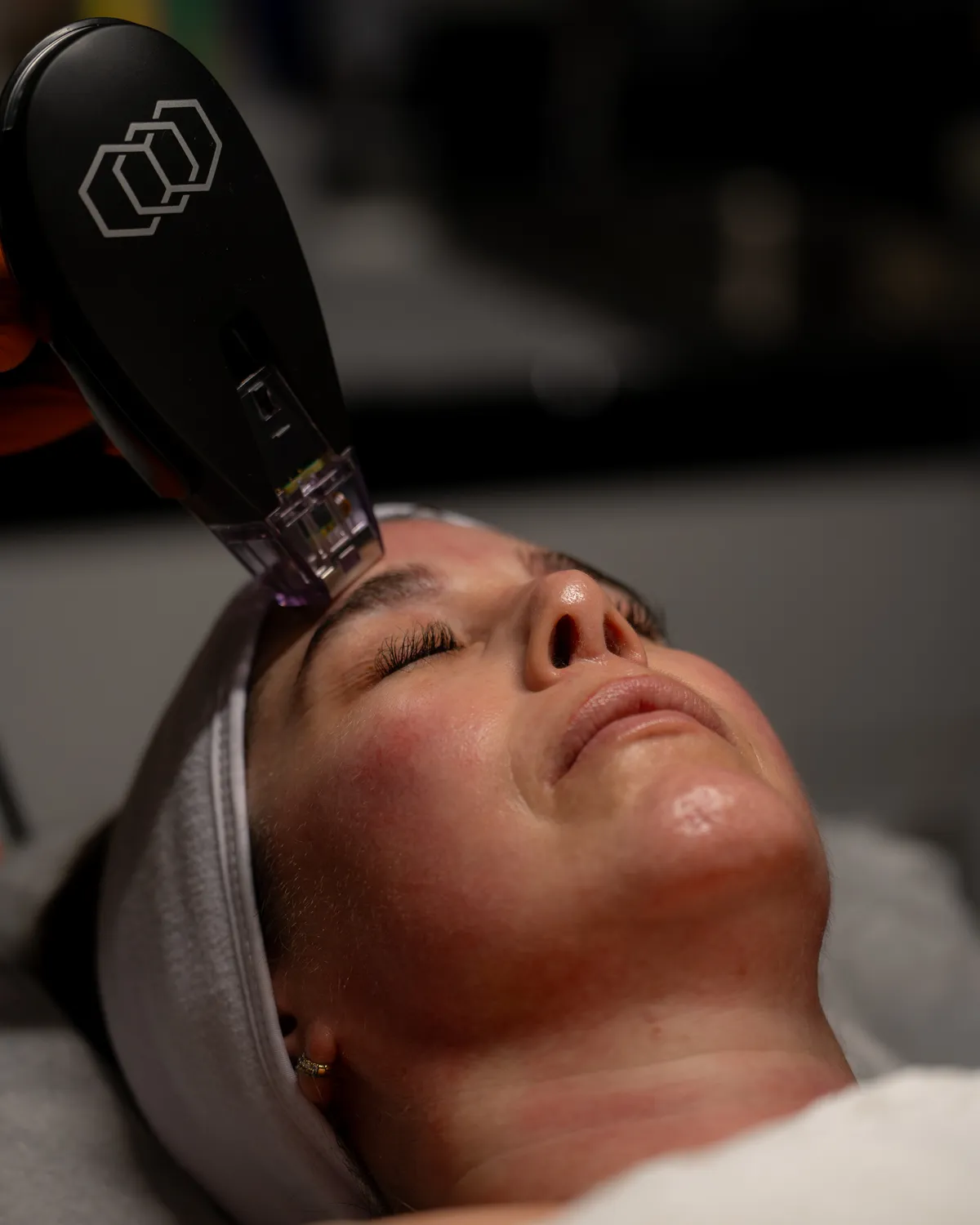 The Morpheus8 handpiece held at a guest's forehead during treatment