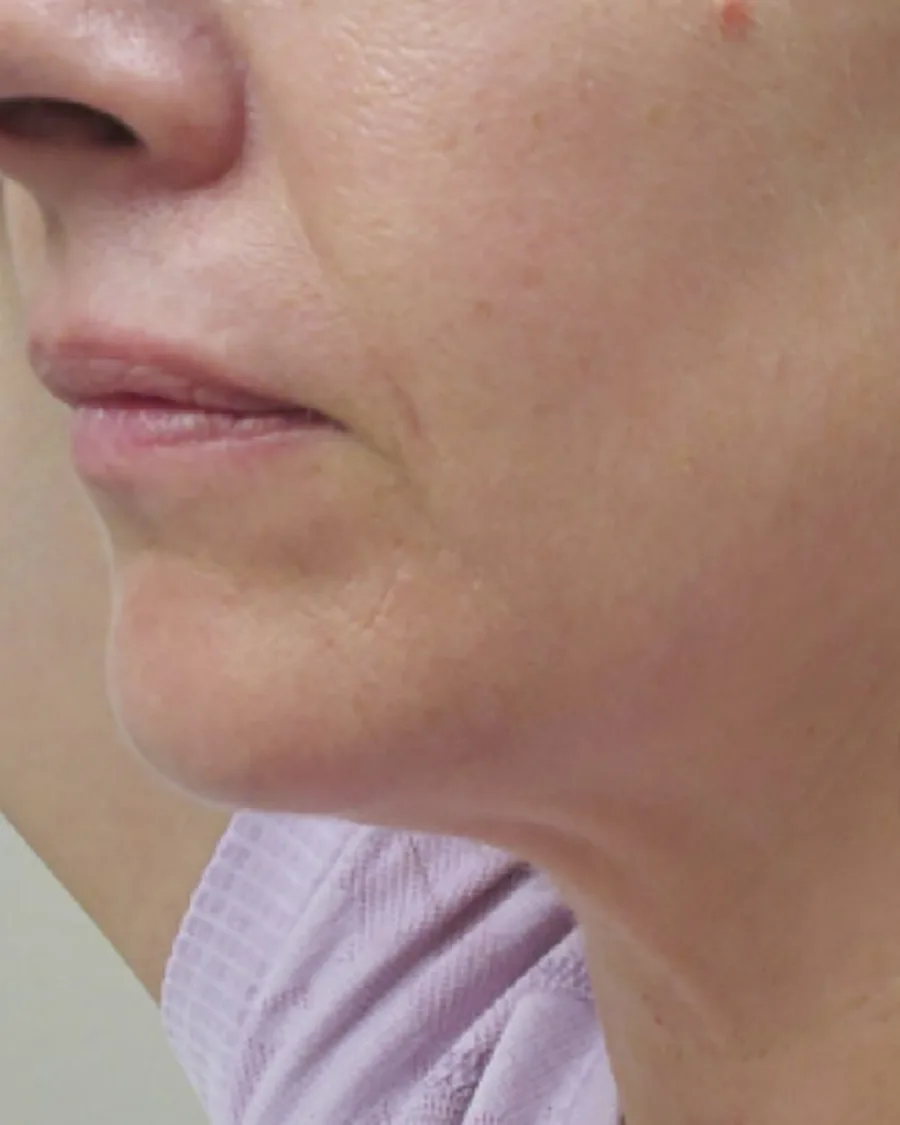 The jawline and neck of a woman in profile, after treatment