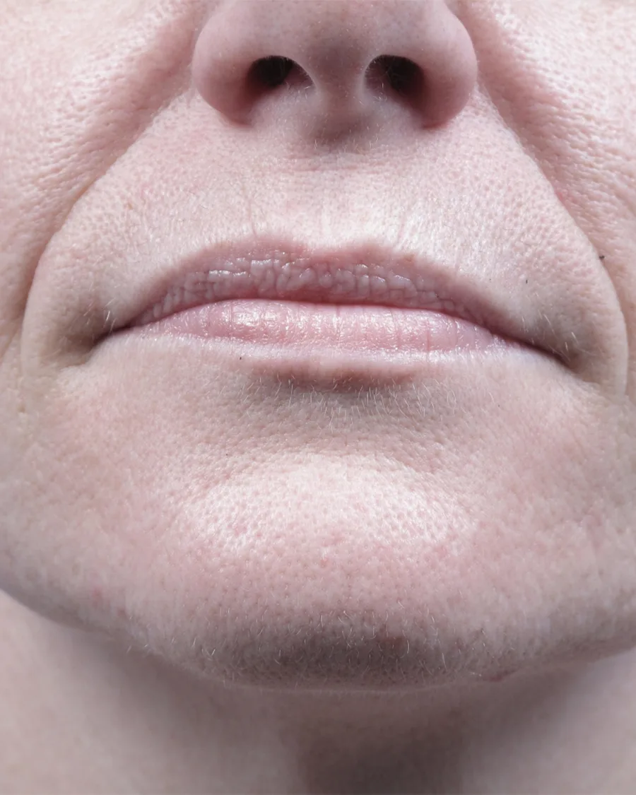 The lower face of a woman, before treatment