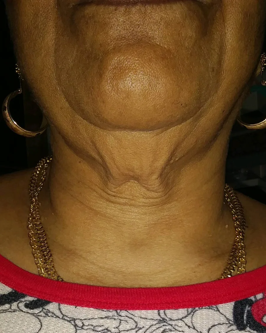 The neck of a woman, before treatment