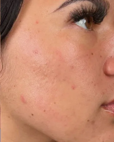 The cheek of a woman with breakouts, after treatment