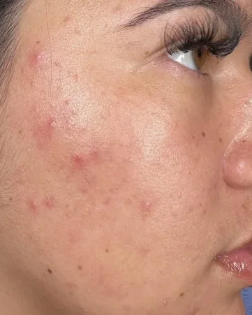 The cheek of a woman with breakouts, before treatment