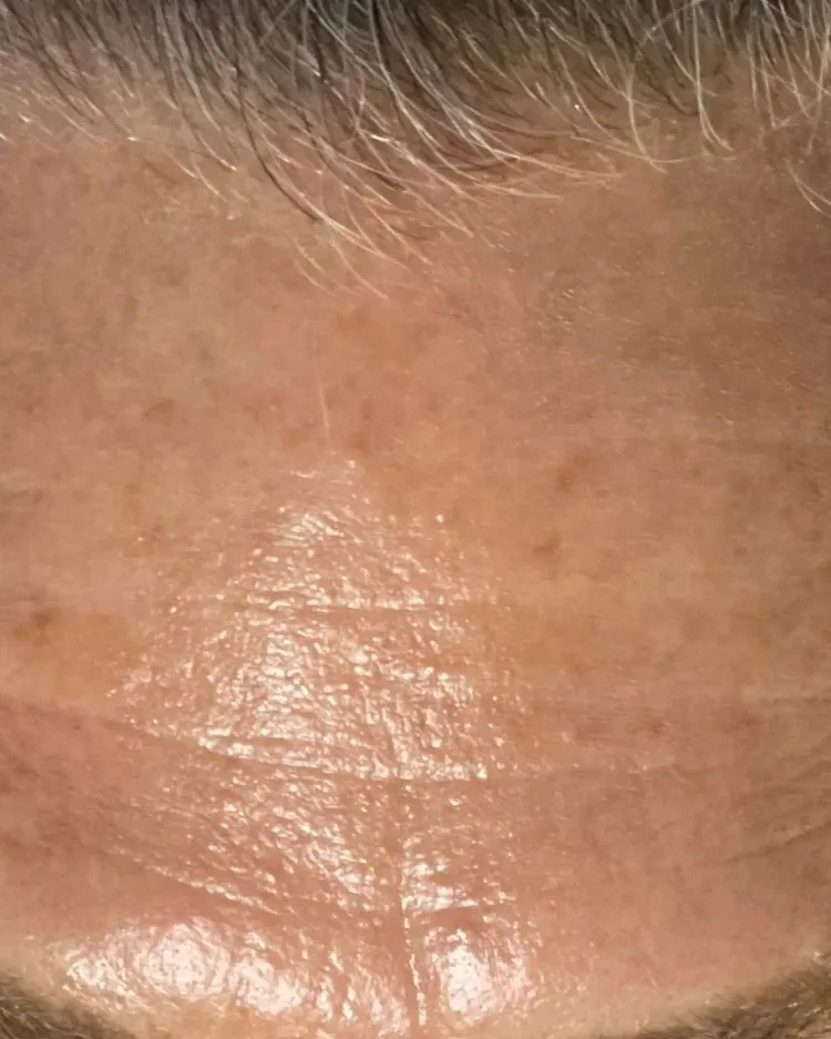 A forehead with fine lines, after treatment