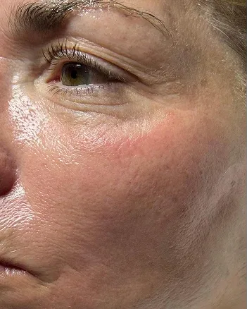 The cheek and eye area of a woman with fine lines, after treatment