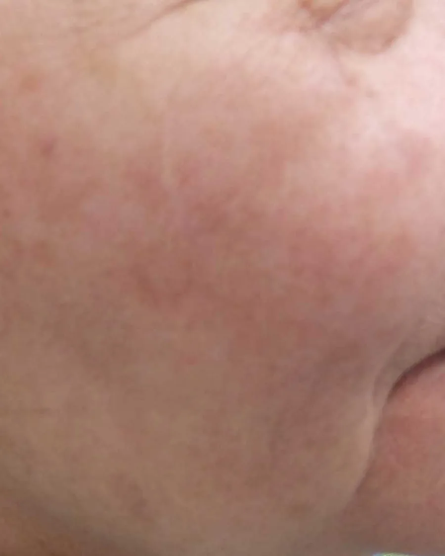 The cheek of a woman with sun spots, after treatment