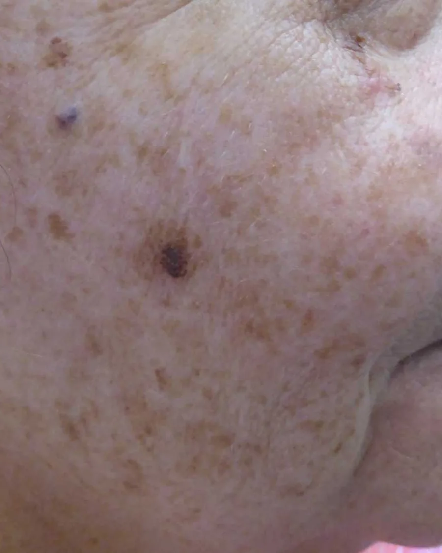 The cheek of a woman with sun spots, before treatment