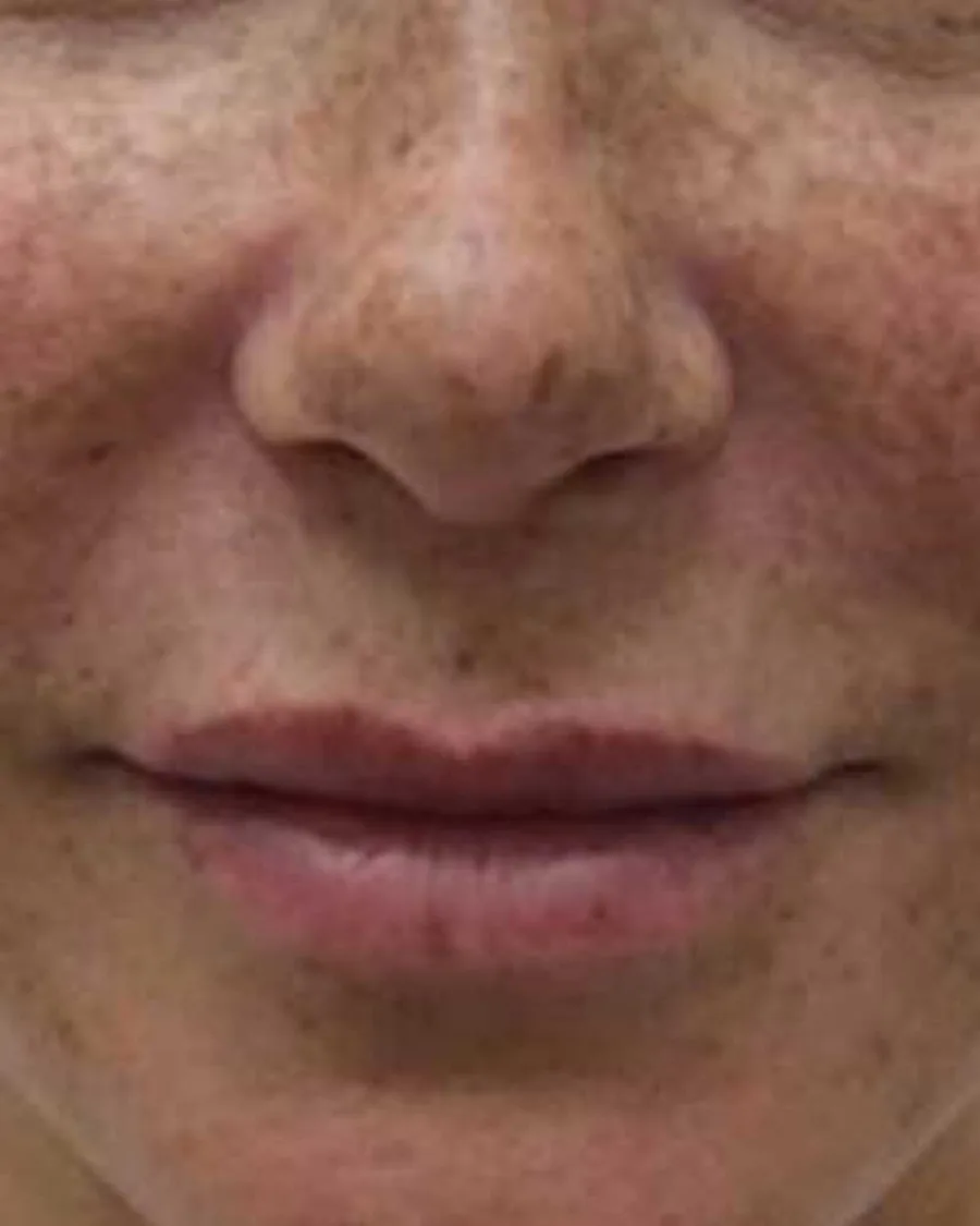 The lower face of a woman with freckles across both cheeks, before treatment