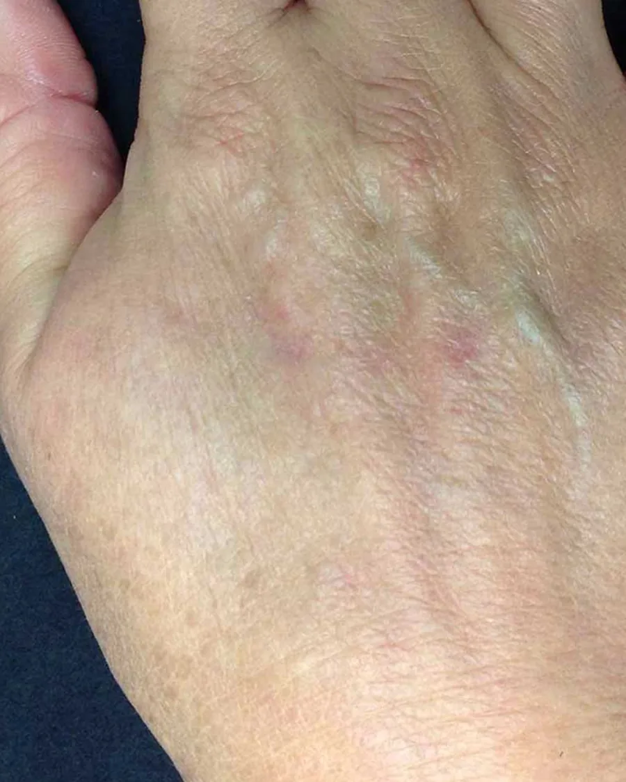 The back of a woman's hand with sun spots, after treatment