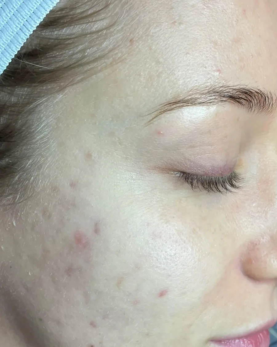The cheek of a young woman with acne marks, after treatment