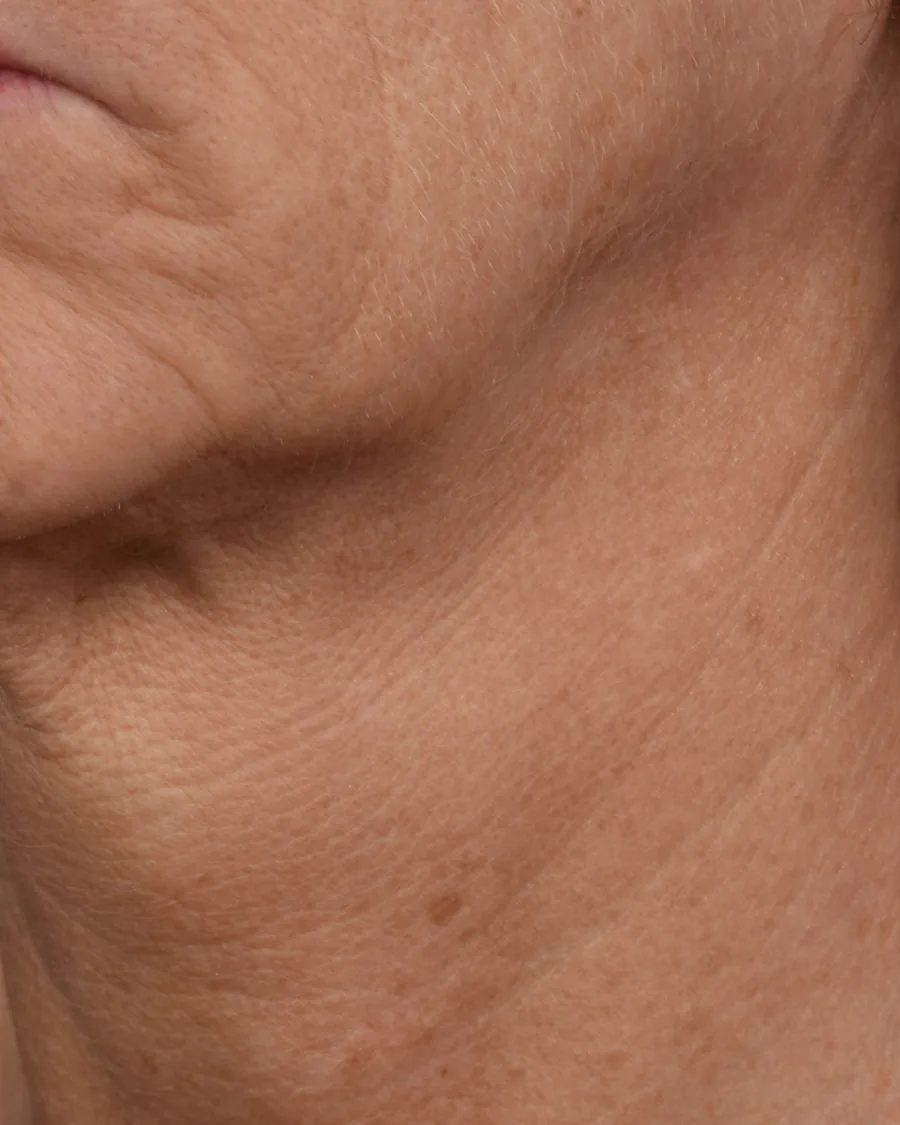 The side of a woman's neck and jaw, after treatment