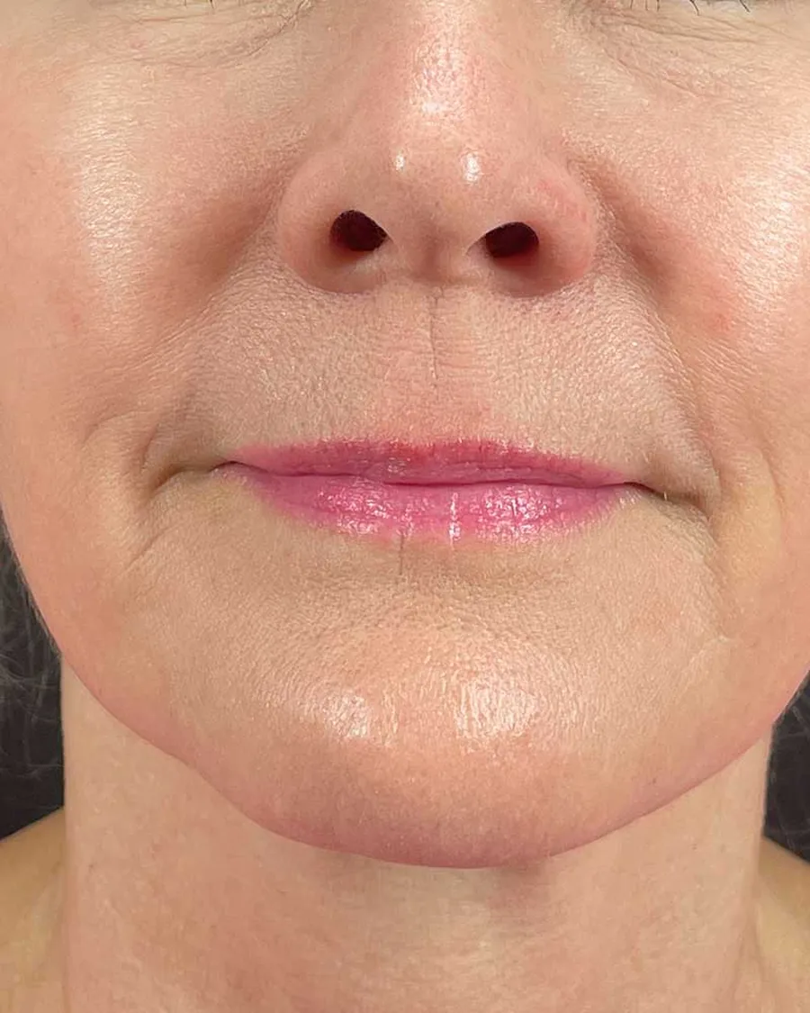 The lower face of a woman, after treatment