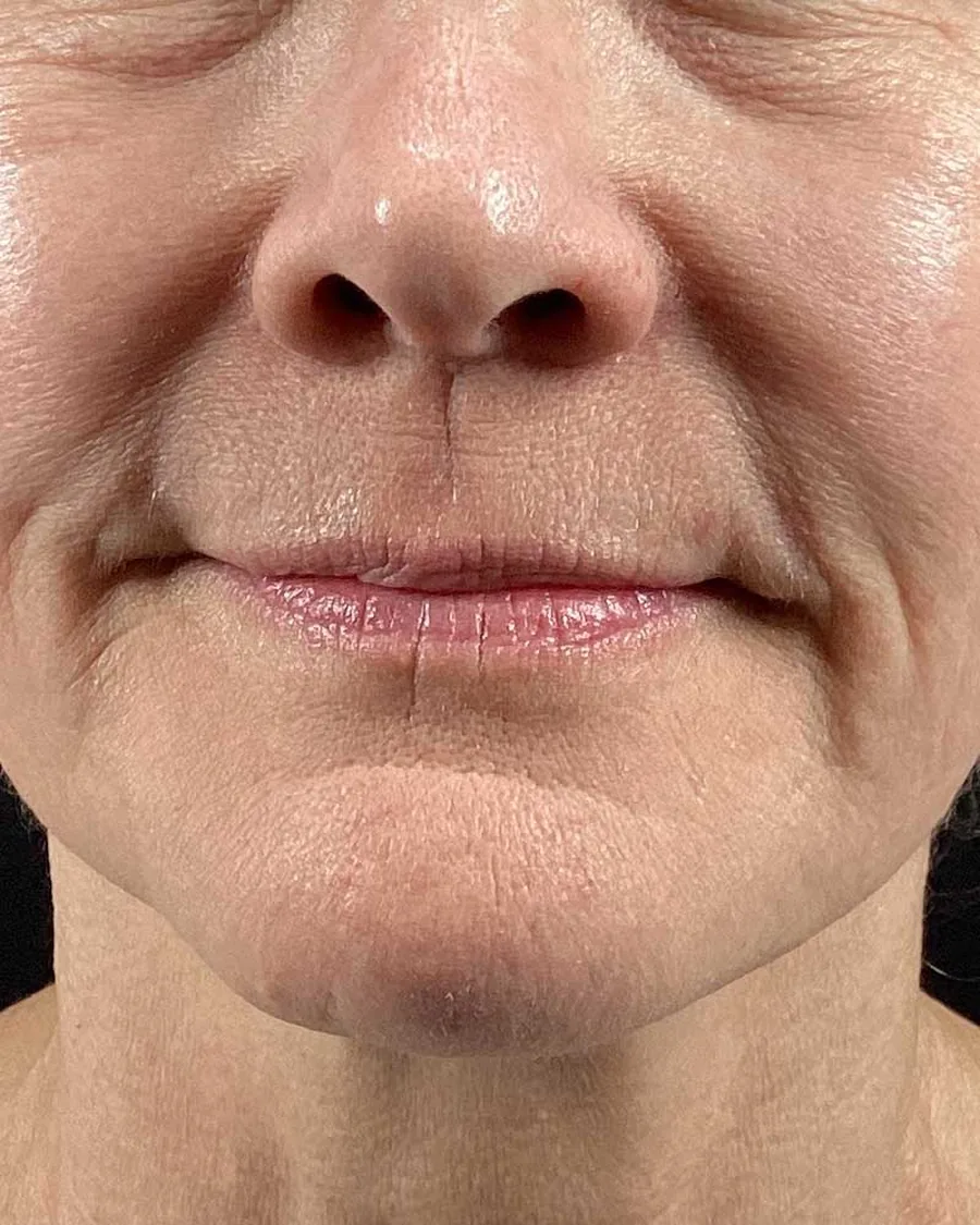 The lower face of a woman, before treatment