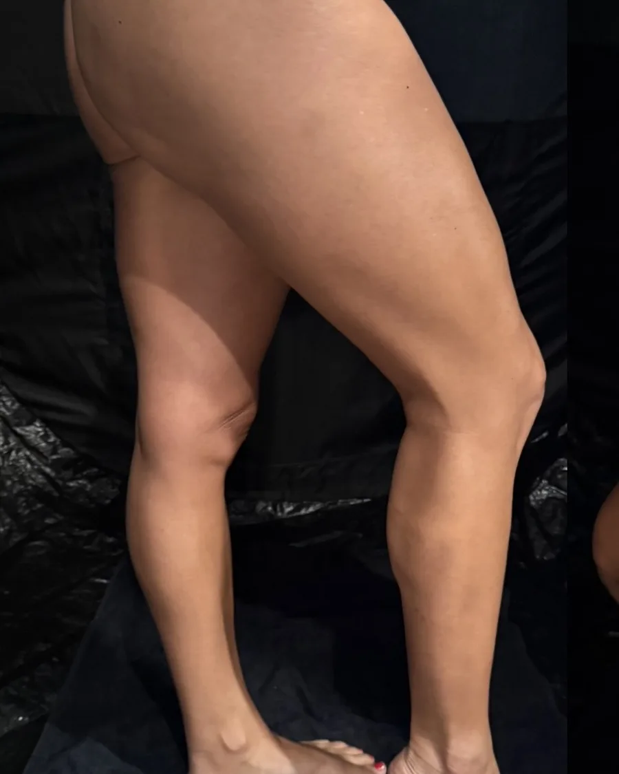 A woman's legs, before treatment